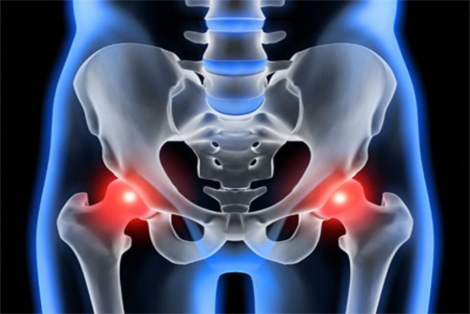 Arthrosis of the hip joints (coxarthrosis)