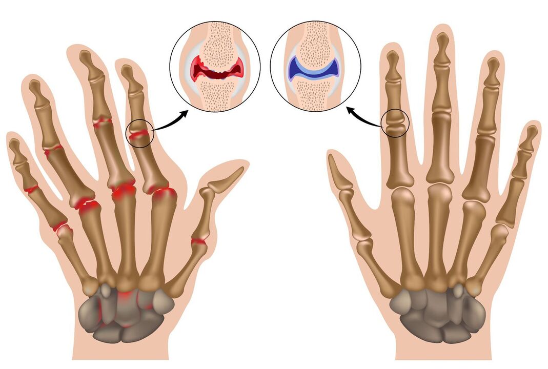 Healthy and arthritic hand joints