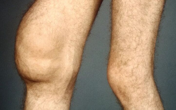 Knee joint -troumatic arthrosis