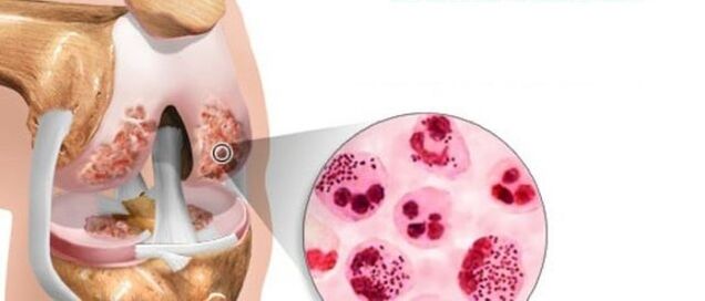 That leads to the development of arthrosis