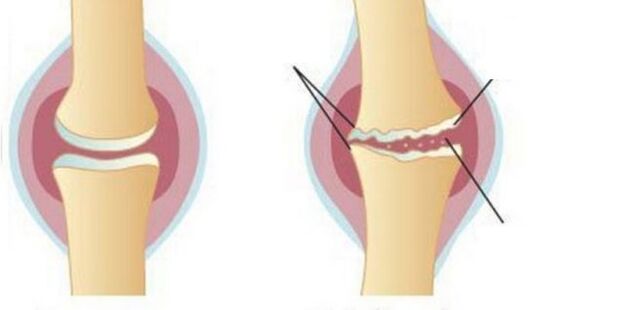 Washing cartilage