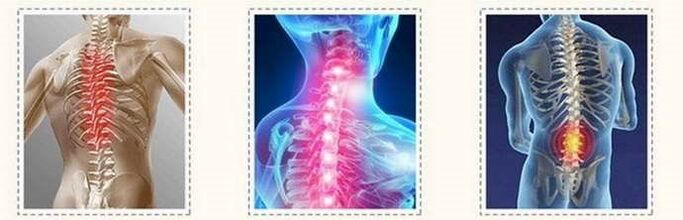 Osteochondrosis of the spinal cord