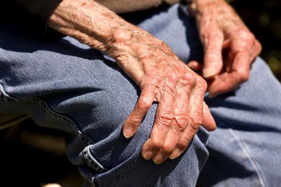Arthritis is an age-related disease that occurs in the elderly
