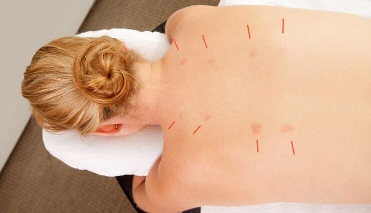 Acupuncture in thoracic osteochondrosis, which has many advantages