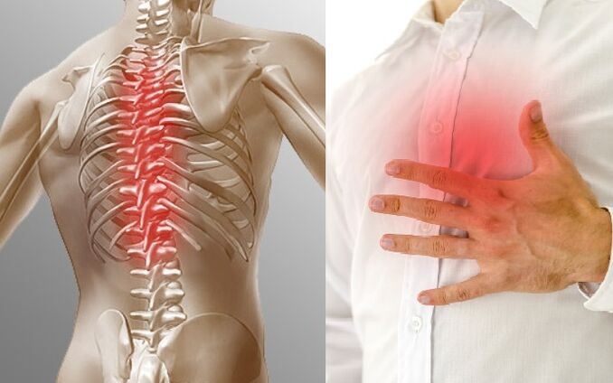 Osteochondrosis of the chest is manifested by pain and a feeling of tightness in the chest